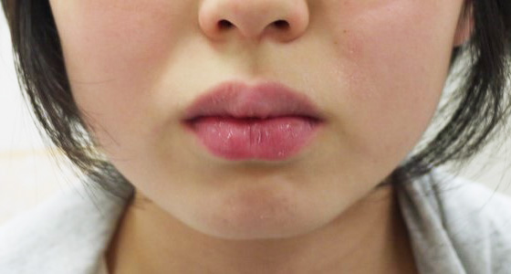 乾燥した口唇　口呼吸の特徴
